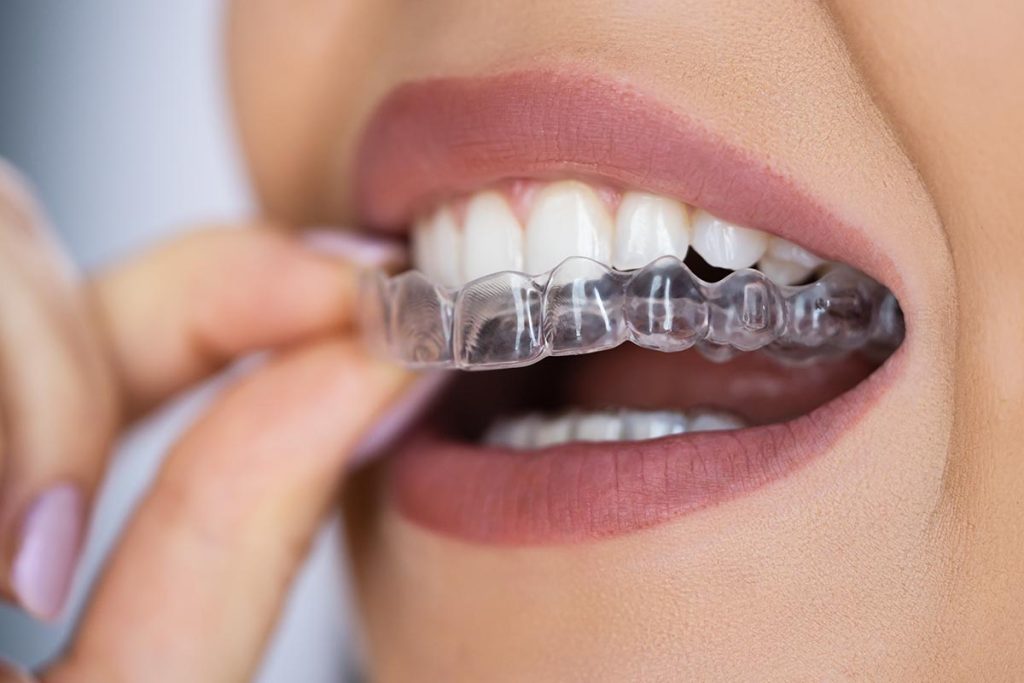 Allineamento Denti