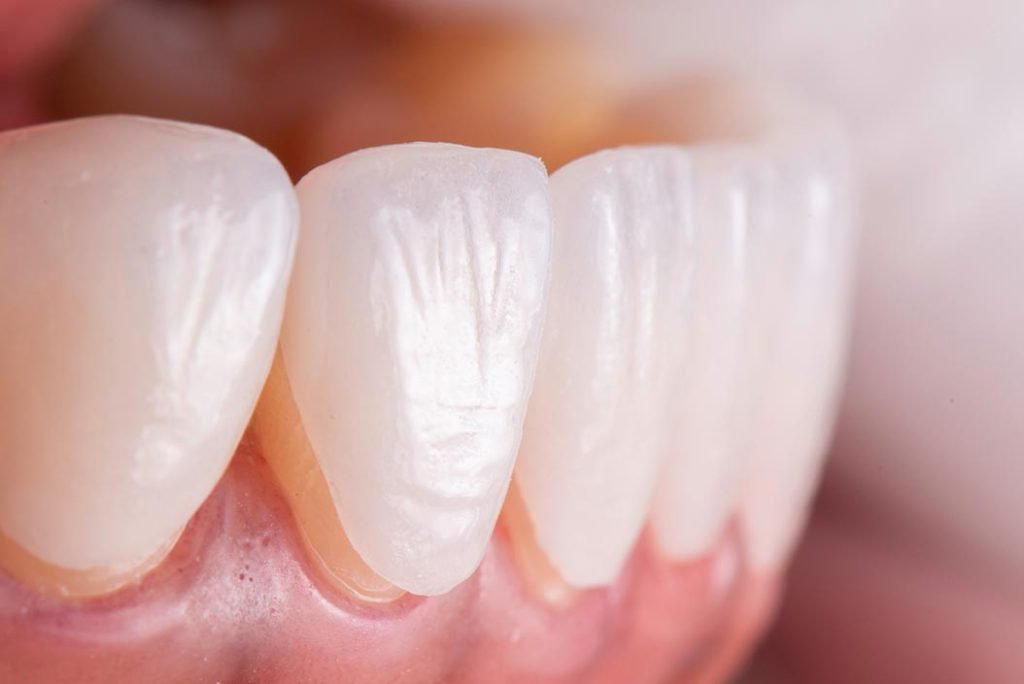 Trattamento facette dentali con dentista estetico