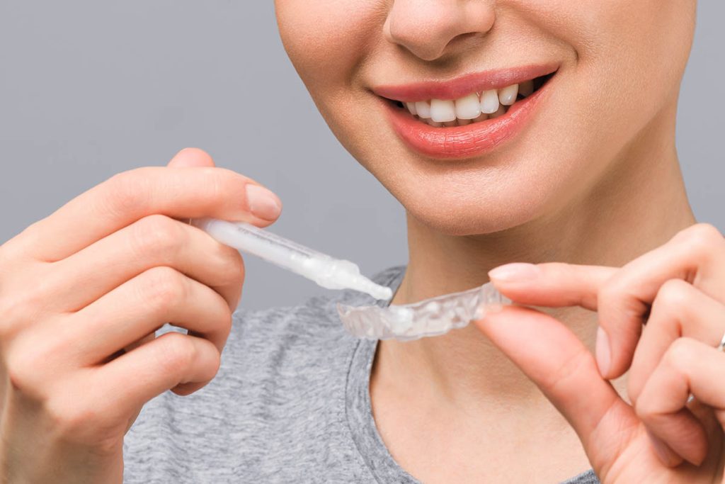 Sbiancamento dentale domiciliare