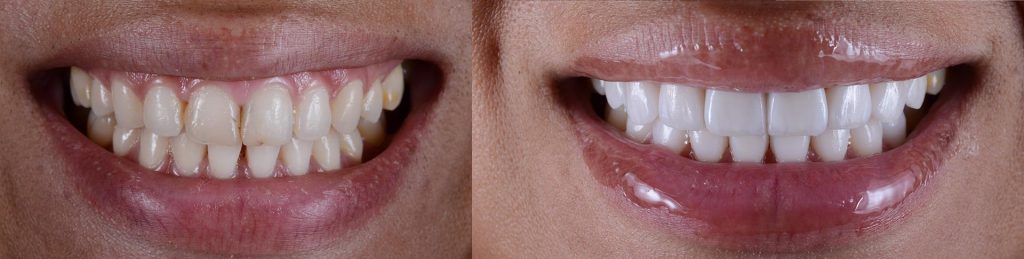 Vantaggi di un restyling del sorriso con un dentista estetico