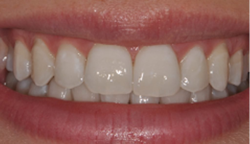 Estetica dentale e Faccette Dentali in ceramica