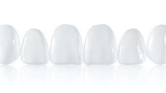 Faccette Dentali Estetiche