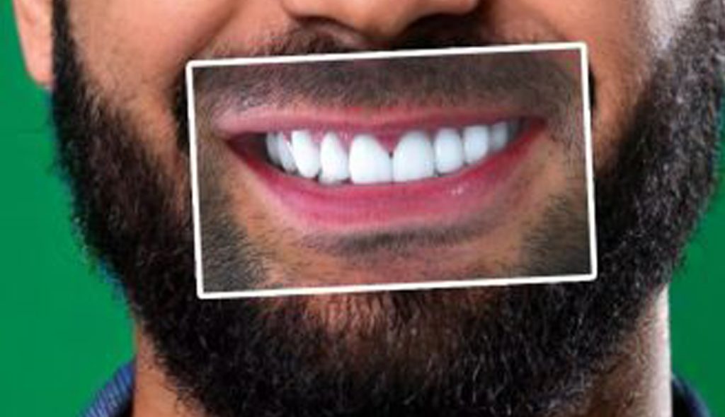 Luca 33 anni – Ortodonzia INVISALIGN