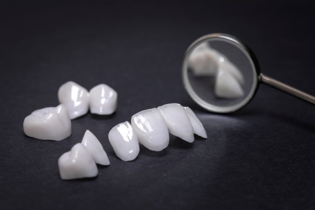 L’ importanza delle Faccette dentali e degli Intarsi in ceramica.