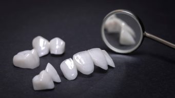 Faccette Dentali Estetiche e Intarsi in ceramica