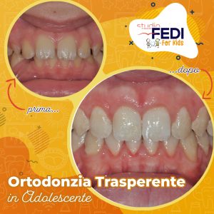 Ortodonzia Trasparente in Adolescente