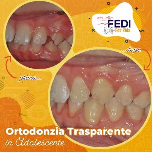 Ortodonzia Trasparente in Adolescente