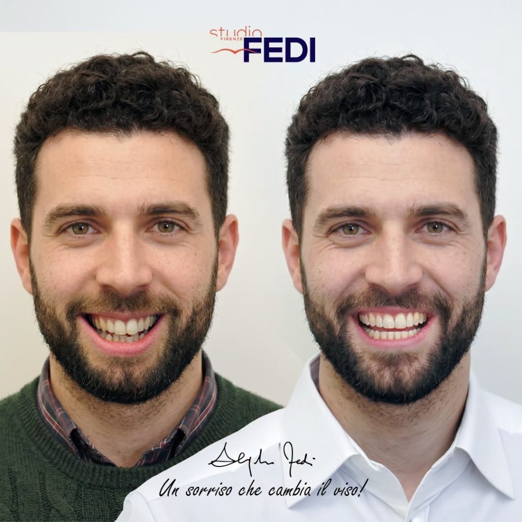 Ortodonzia Invisibile e Sbiancamento Dentale